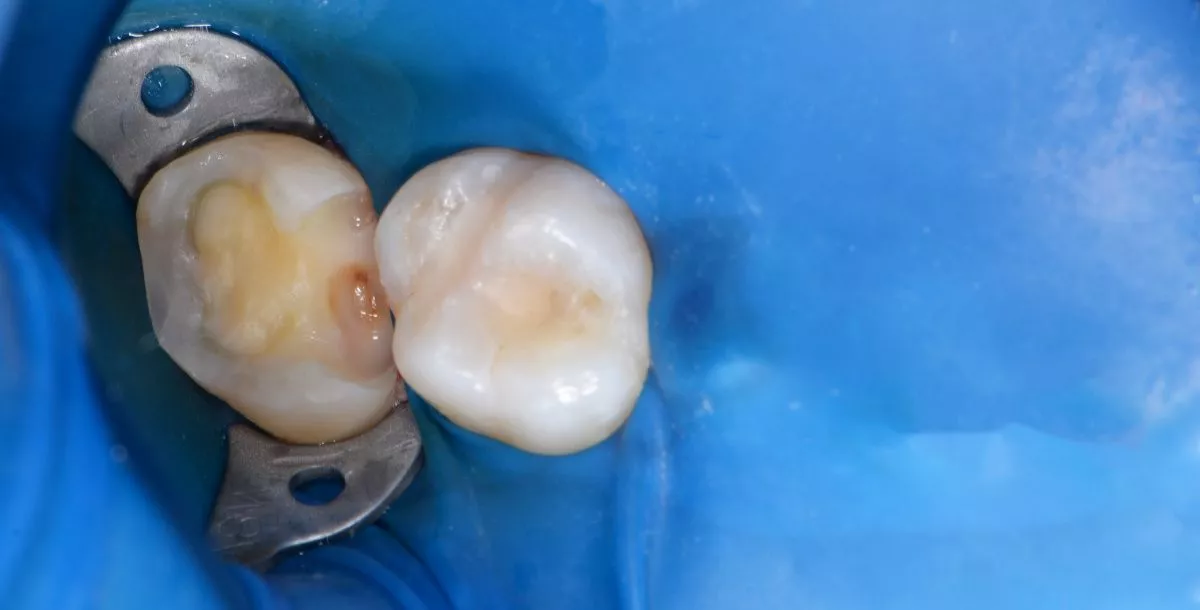 Лучшие стоматологические клиники. Глубокий кариес с риском пульпита – терапевтический подход - до процедуры