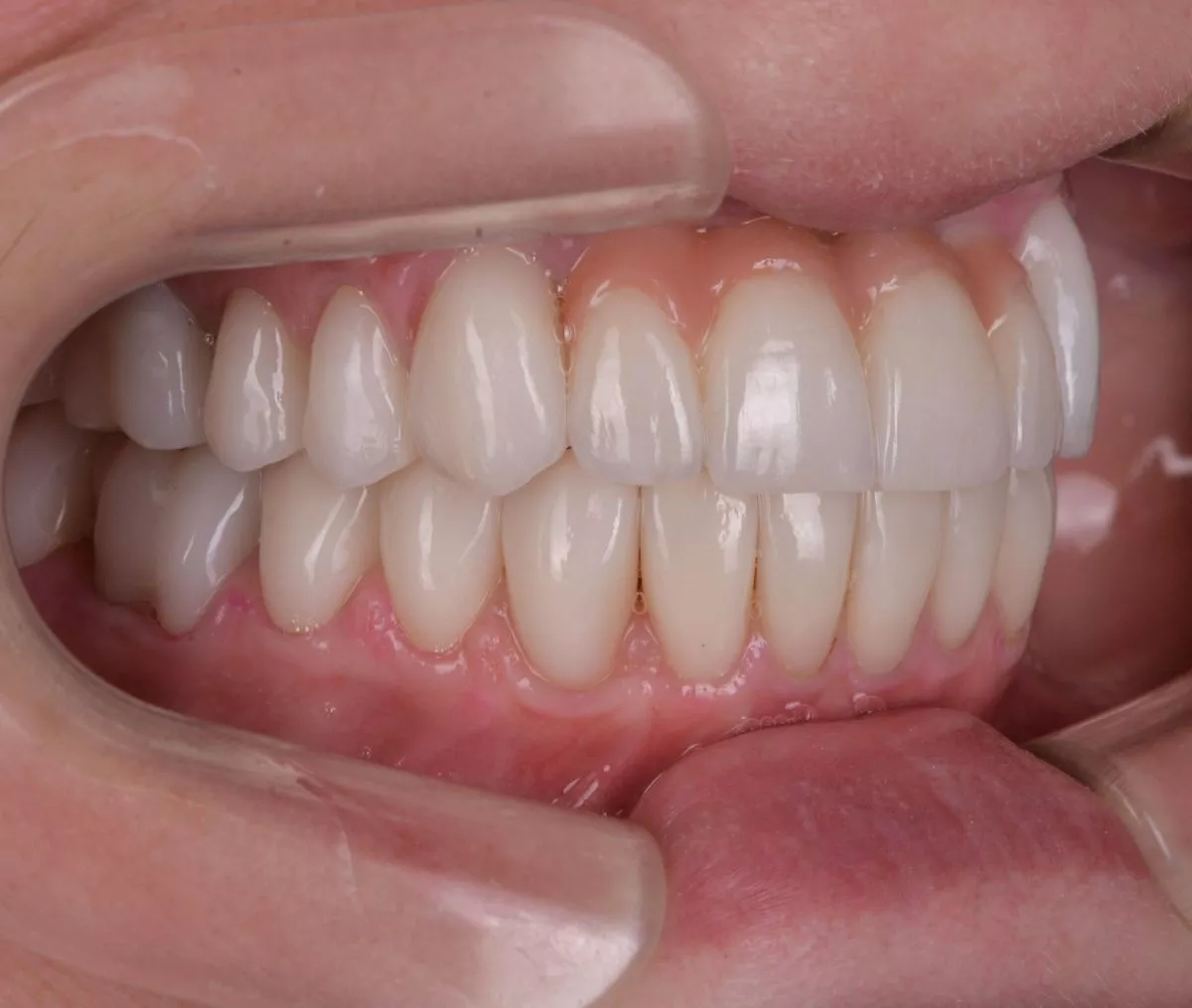 Премиум стоматологии Москва. Замена старых коронок и установка виниров