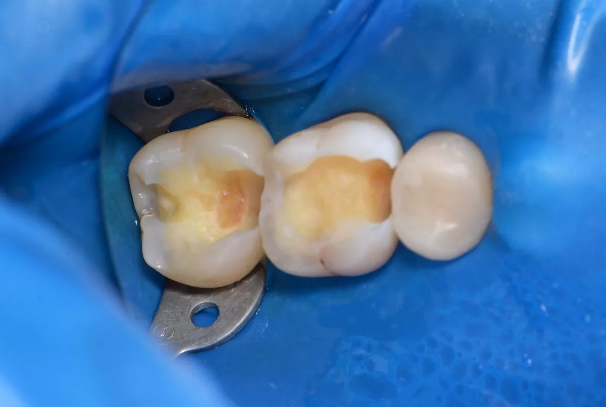 Лучшие стоматологические клиники. Лечение глубокого кариеса - до процедуры