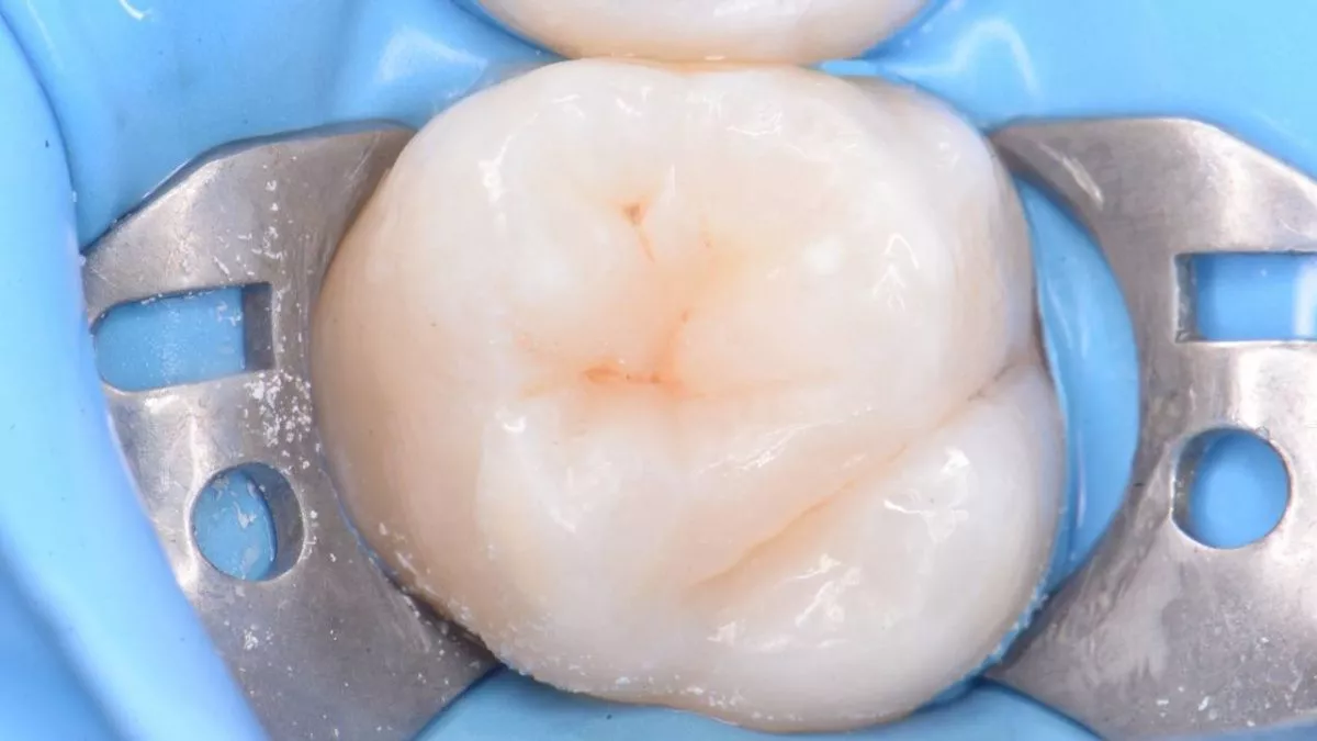 Стоматология Москва лучшие клиники. Лечение кариеса. Композитная реставрация с восстановлением функциональных ориентиров