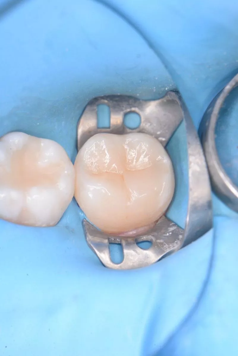 Стоматология Москва лучшие клиники. Замена  старой пломбы с вторичным кариесом. Реставрация с использованием композитного материала