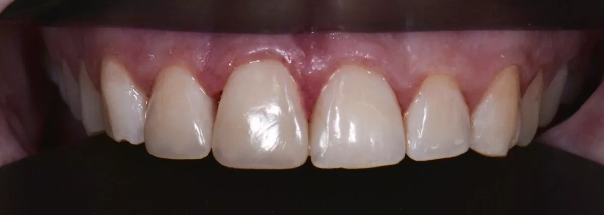 Стоматологии премиум класса в Москве. Художественная реставрация передних зубов