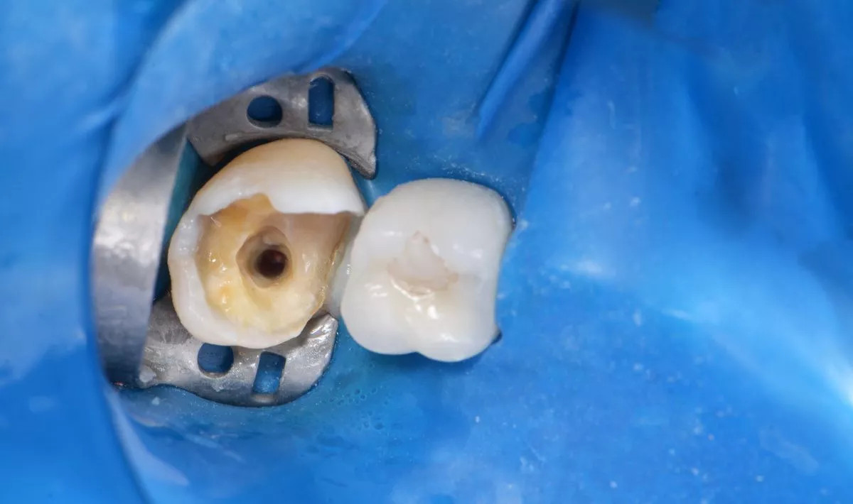 Лучшие стоматологические клиники. Лечение скрытого кариеса под старой пломбой - до процедуры