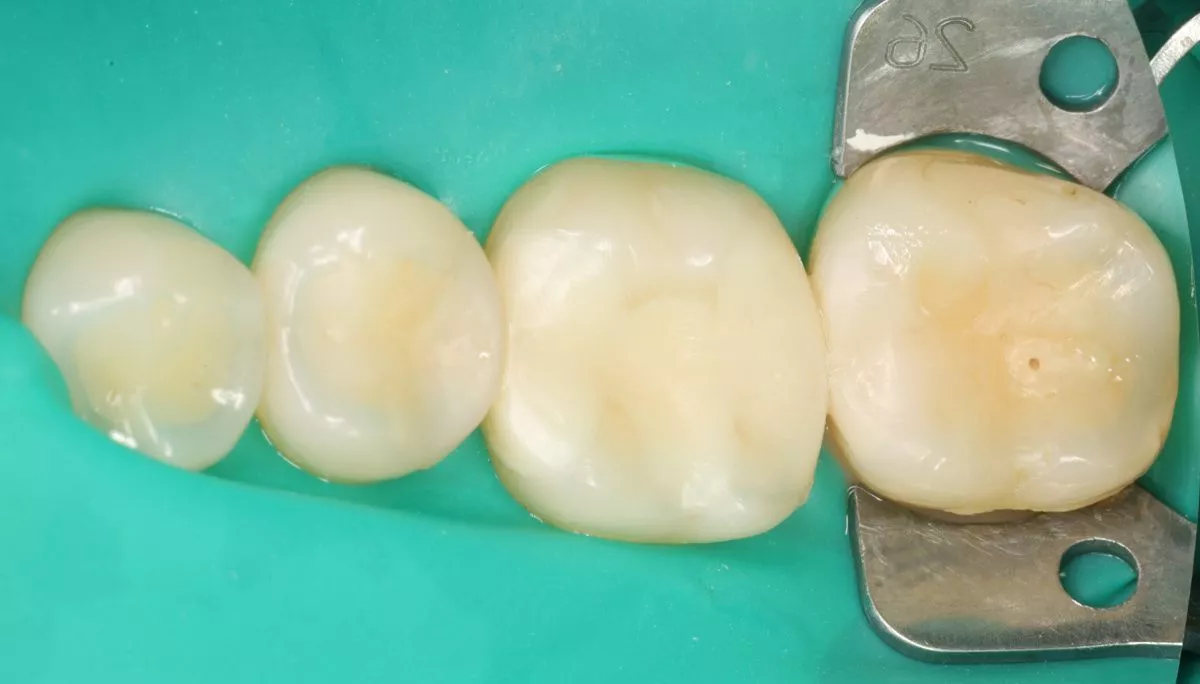 Стоматология премиум класса. Поверхностный кариес: лечение на ранней стадии - до процедуры