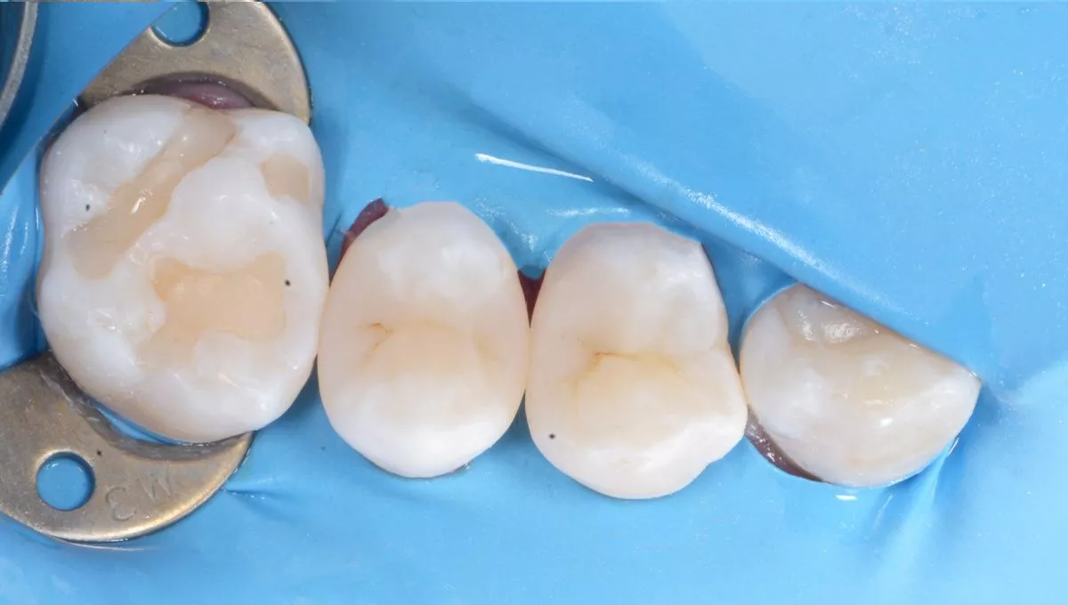 Стоматологии премиум класса в Москве. Контактный кариес с восстановлением контактного пункта