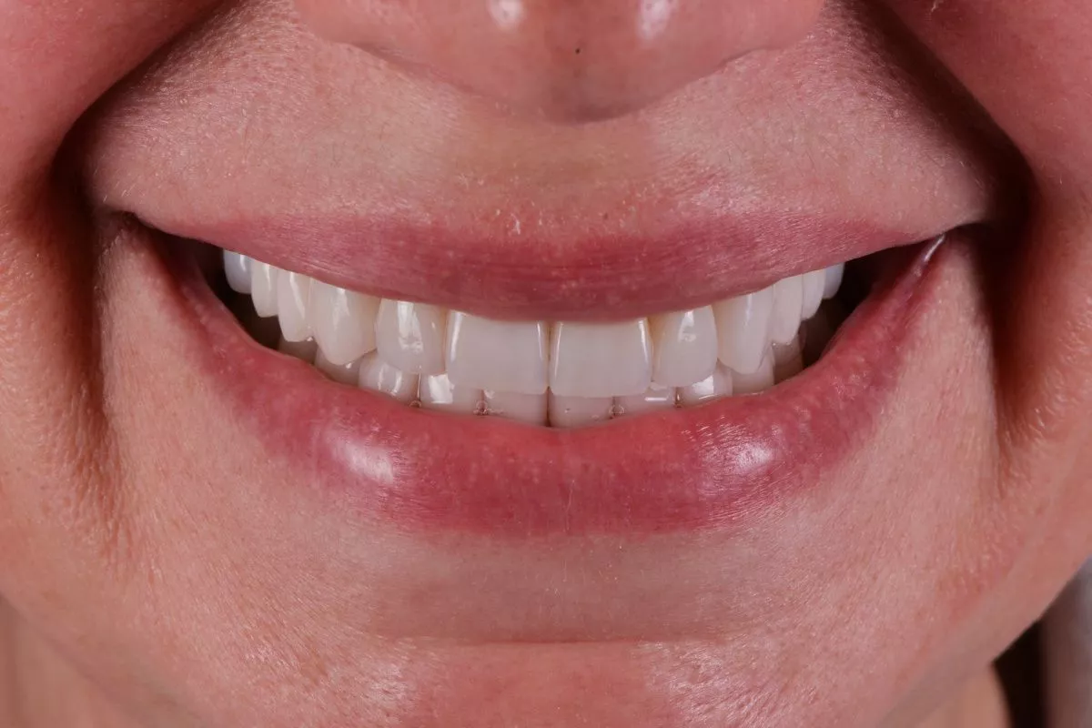 Премиум стоматологии Москва. Восстановление эстетики зубов винирами и коронками