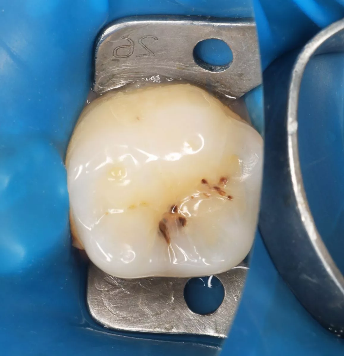 Стоматология премиум класса. Скрытый кариес: диагностика и лечение - до процедуры