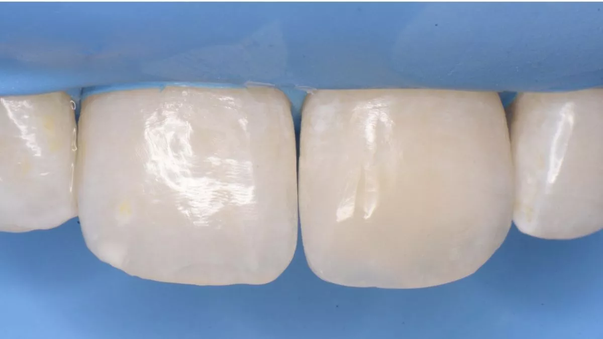 Стоматология Москва лучшие клиники. Художественная реставрация переднего зуба с использованием композита. Восстановление оптики зуба