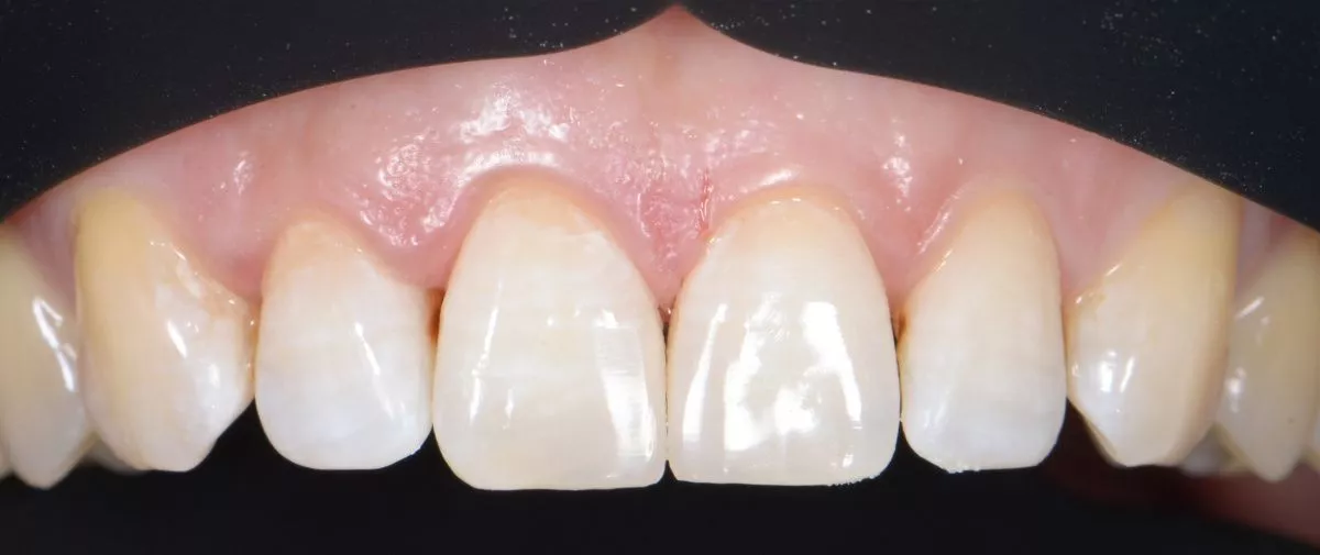 Лучшие стоматологические клиники. Улучшение эстетики зубов после реставрации сколов