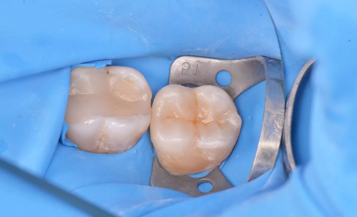 Лучшая стоматология. Лечение кариеса жевательного зуба