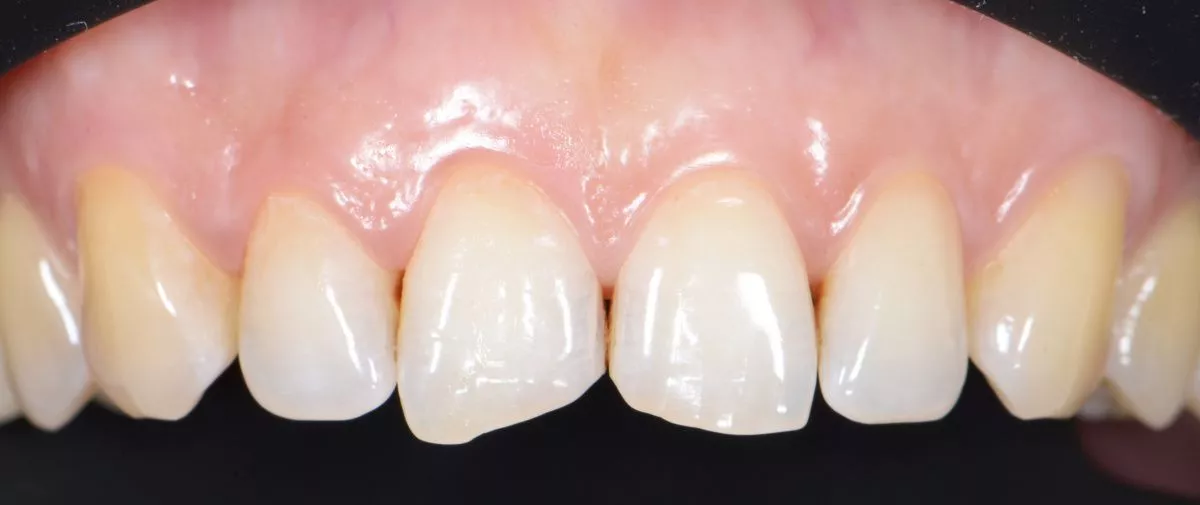 Лучшие стоматологические клиники. Улучшение эстетики зубов после реставрации сколов - до процедуры