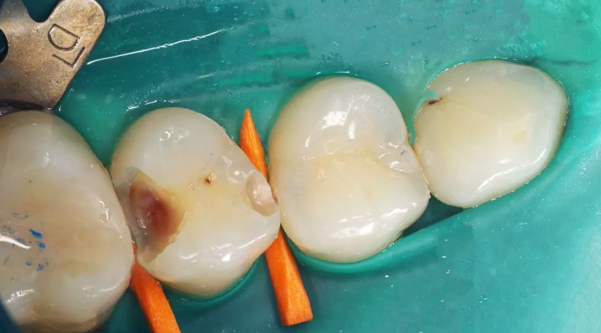 Стоматология премиум класса. Лечение контактного кариеса - до процедуры