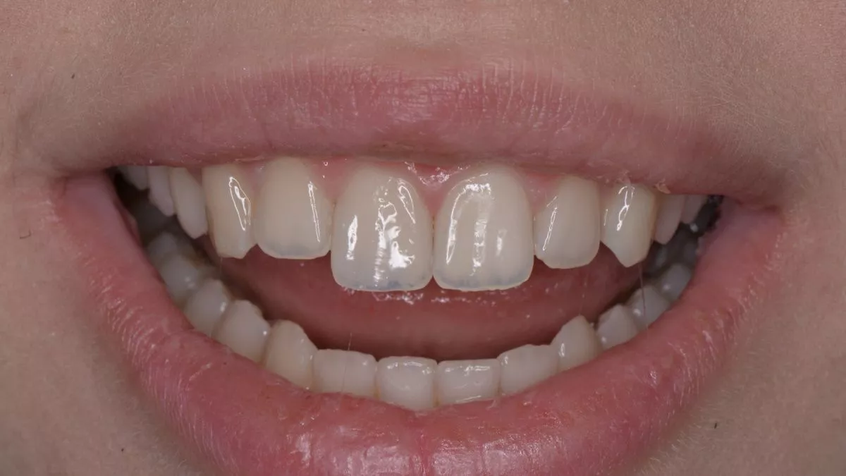 Стоматология Москва лучшие клиники. Художественная реставрация зуба композитным материалом с восстановлением всех оптических характеристик за один визит.