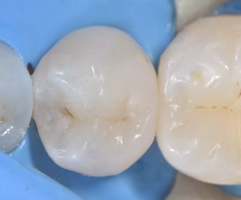 Стоматология Москва лучшие клиники. Лечение контактного кариеса