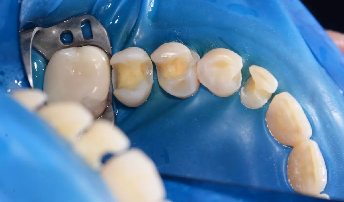 Лучшие стоматологические клиники. Лечение нескольких кариесов зубов за один визит - до процедуры