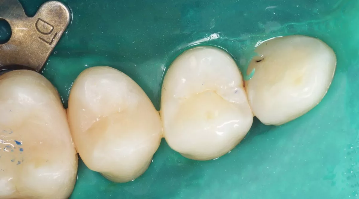 Стоматология премиум класса. Лечение контактного кариеса