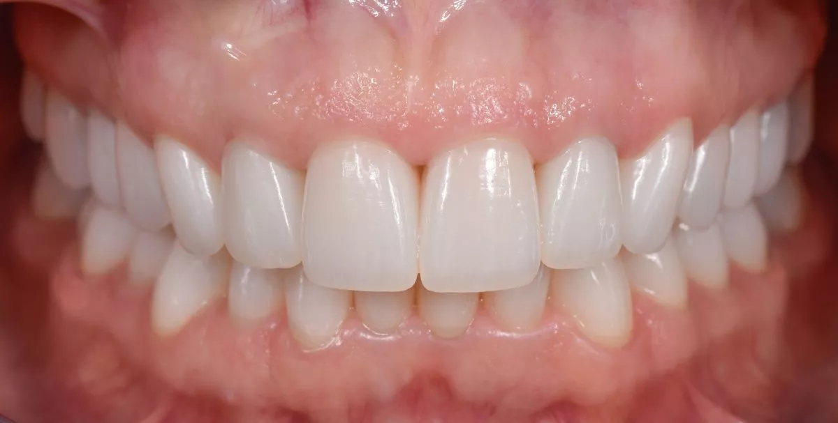 Фото после процедуры