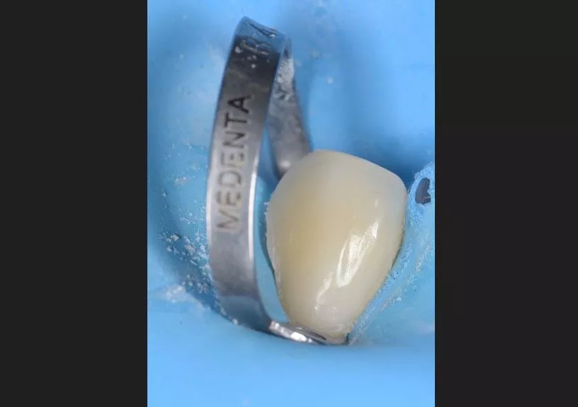 Стоматология Москва лучшие клиники. Лечение клиновидного дефекта