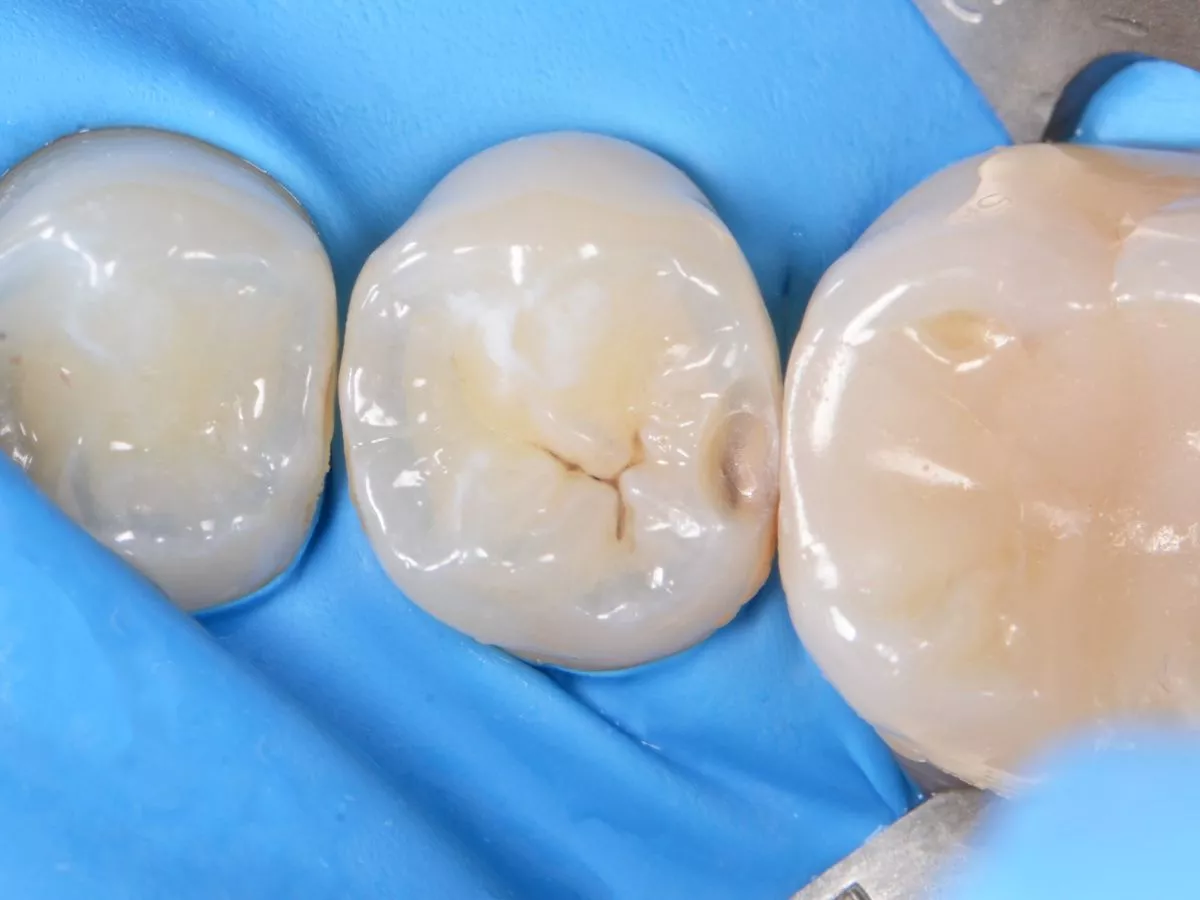 Где лучшая стоматология? Лечение контактного кариеса - до процедуры