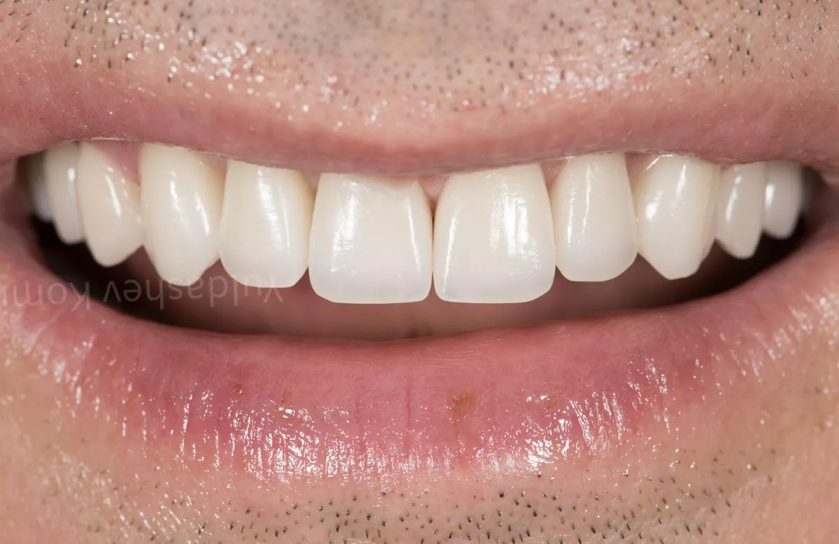 Где лучшая стоматология в Москве? Возвращение эстетики улыбки - установка керамических виниров и коронок