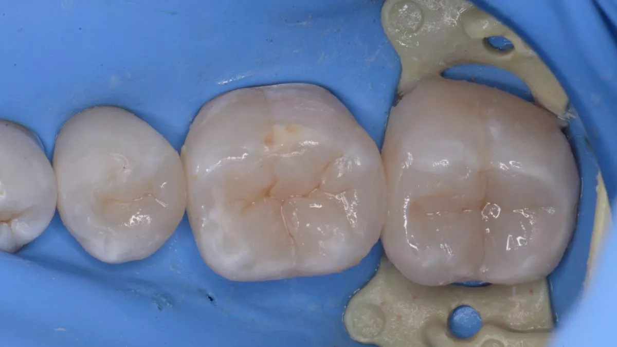 Стоматология Москва лучшие клиники. Замена старых пломб с лечением кариеса. Восстановление зубов с восстановлением анатомических ориентиров