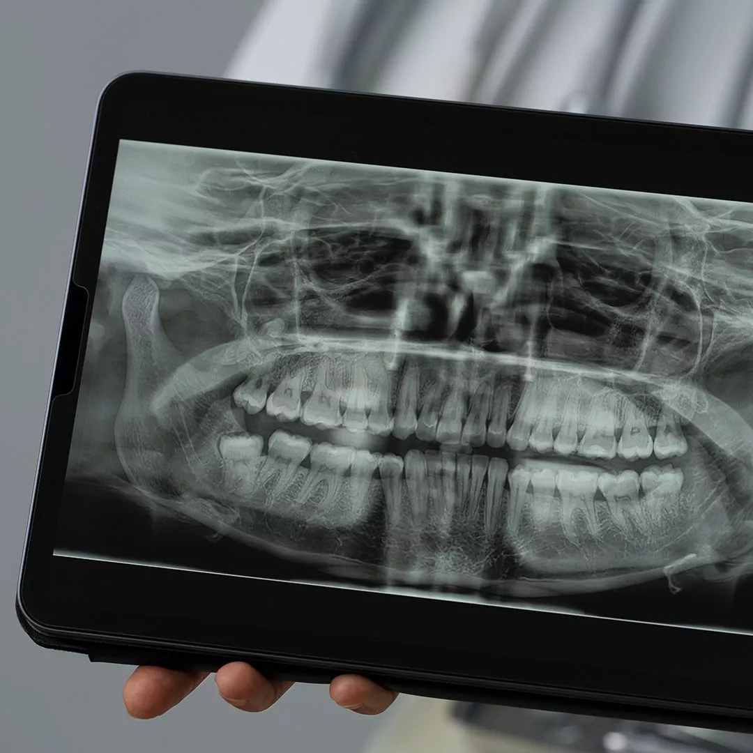 Ортопантомография (ОПТГ)