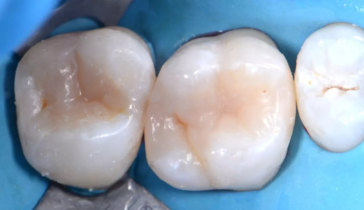 Где лучшая стоматология? Лечение кариеса с восстановлением анатомии зуба