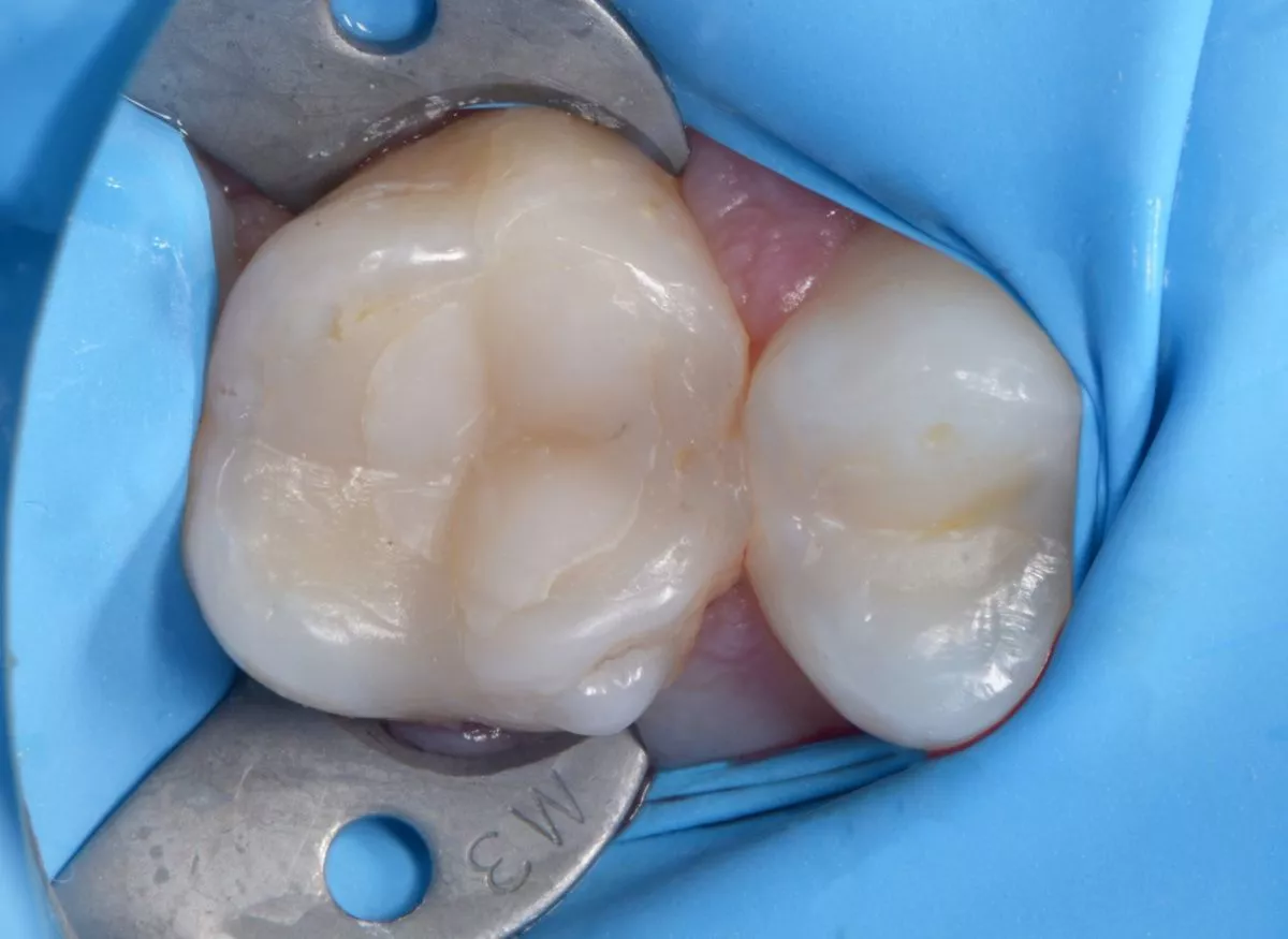 Стоматологии премиум класса в Москве. Скрытый контактный кариес - до процедуры