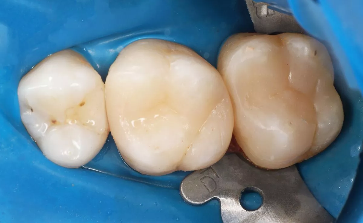 Стоматология премиум класса. Средний кариес с заменой старой пломбы