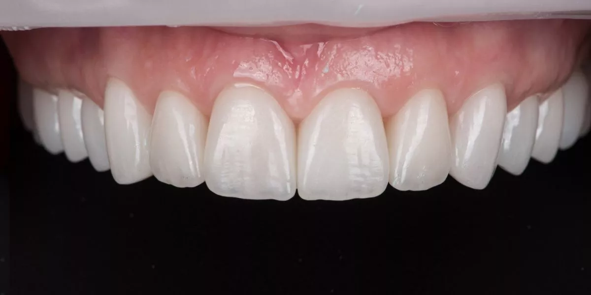 Фото после процедуры