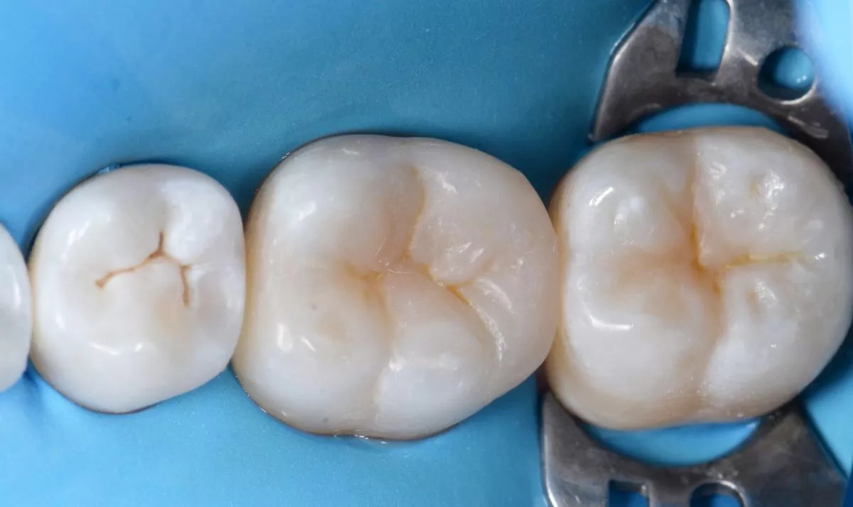 Где лучшая стоматология? Фиссурный кариес: лечение и восстановление естественных фиссур