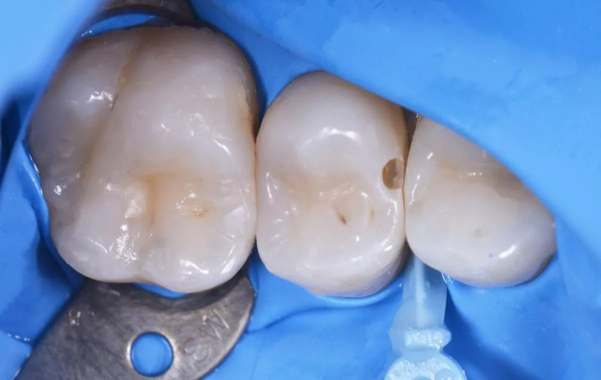 Стоматологии премиум класса в Москве. Глубокий кариес с риском пульпита – терапевтический подход - до процедуры