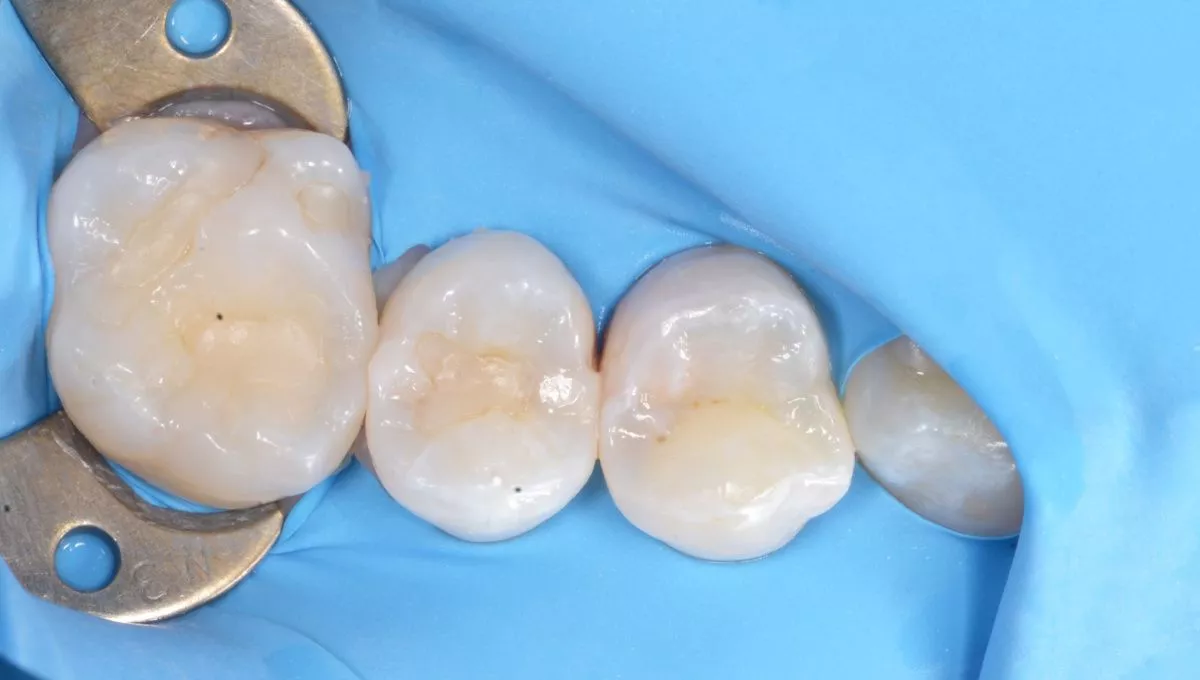 Стоматологии премиум класса в Москве. Контактный кариес с восстановлением контактного пункта - до процедуры