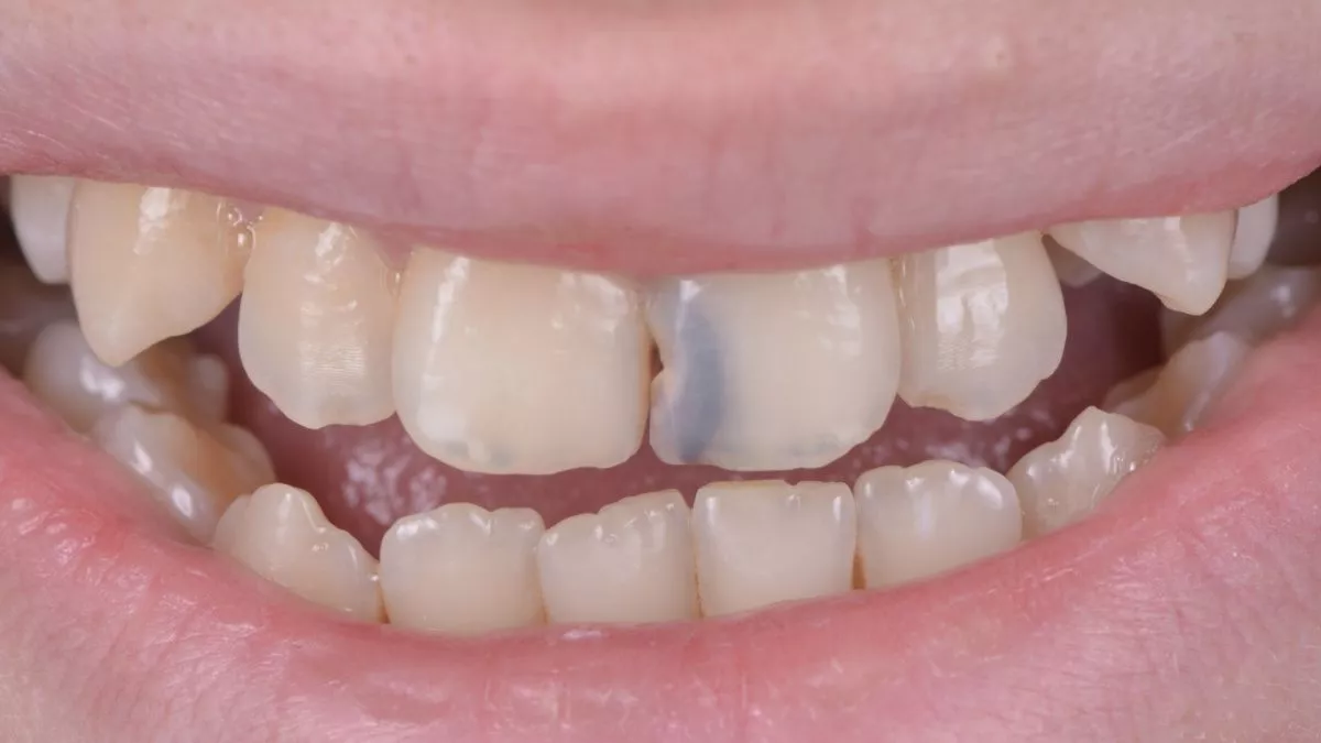 Стоматология Москва лучшие клиники. Лечение кариеса в эстетически значимой зоне. Реставрация зуба с помощью композита - до процедуры