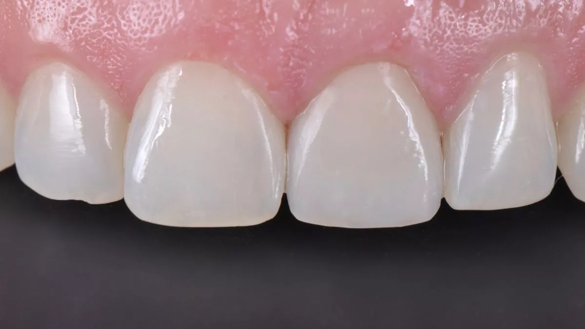 Стоматология Москва лучшие клиники. Прямая реставрация центрального резца со стекловолоконным штифтом