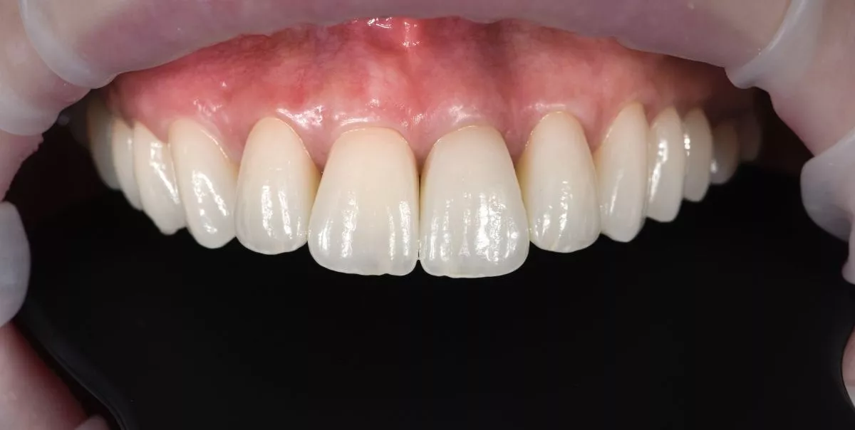 Фото после процедуры