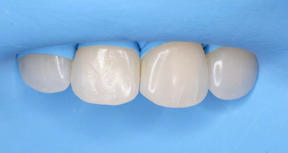 Стоматология Москва лучшие клиники. Лечение межзубного кариеса фронтальных зубов - до процедуры