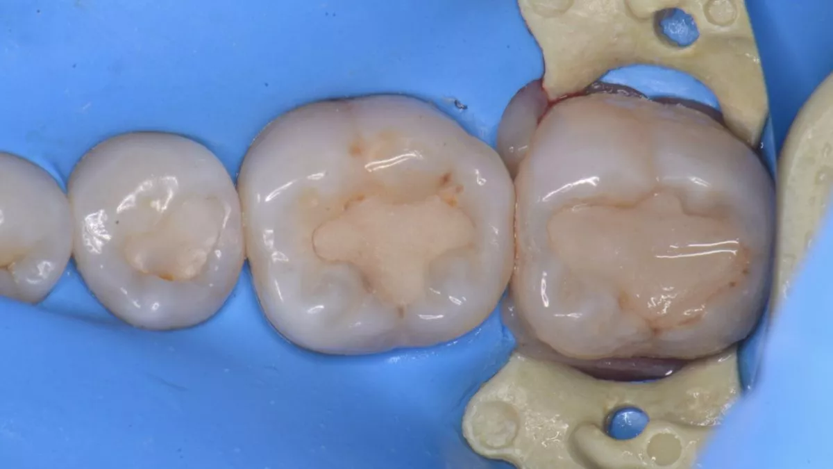 Стоматология Москва лучшие клиники. Замена старых пломб с лечением кариеса. Восстановление зубов с восстановлением анатомических ориентиров - до процедуры