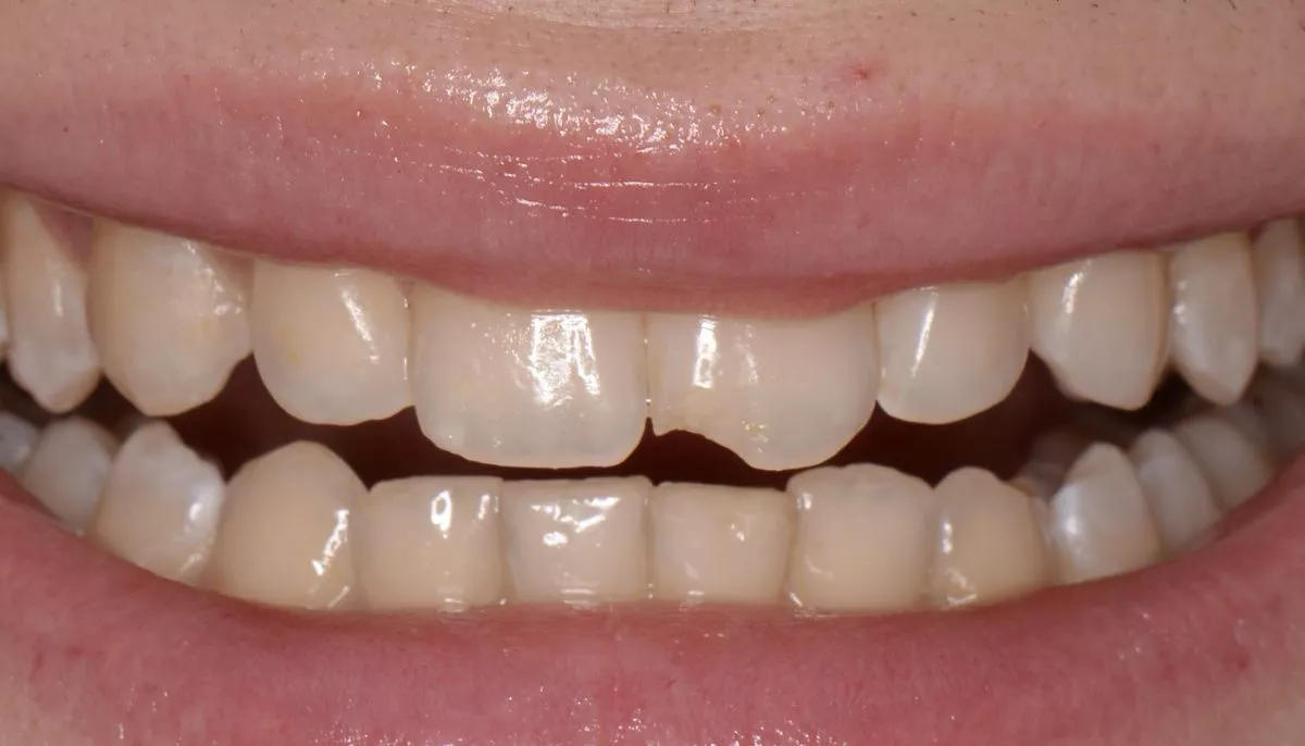 Стоматология Москва лучшие клиники. Художественная реставрация с использованием композитного материала за один визит - до процедуры