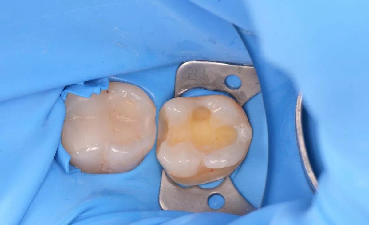 Лучшая стоматология. Лечение кариеса жевательного зуба - до процедуры