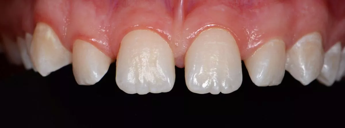 Лучшие стоматологические клиники. Эстетические реставрации в зоне улыбки - до процедуры