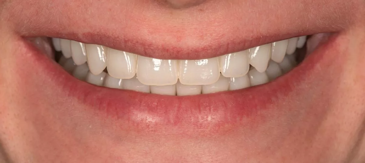 Где лучшая стоматология в Москве? Восстановление эстетики улыбки - установка имплантатов, коронок и виниров