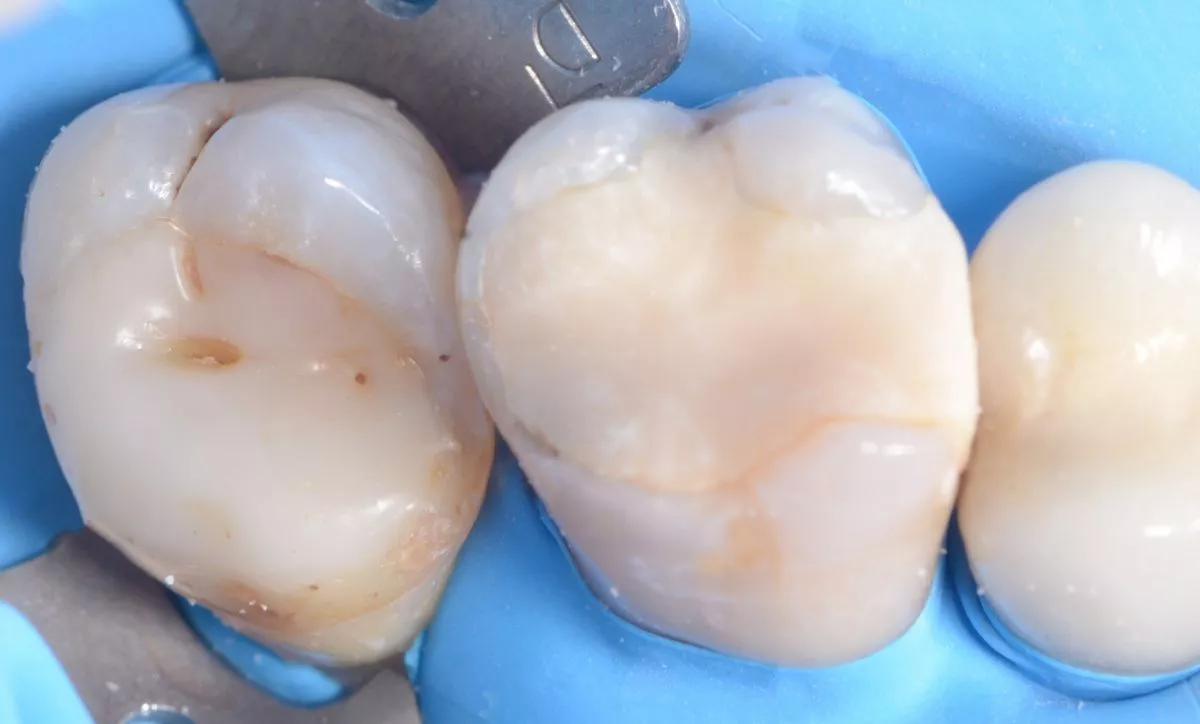 Где лучшая стоматология? Глубокий кариес жевательного зуба – сохранение зуба - до процедуры