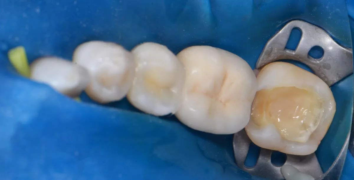 Лучшие стоматологические клиники. Глубокий кариес жевательного зуба – сохранение функции и эстетики - до процедуры