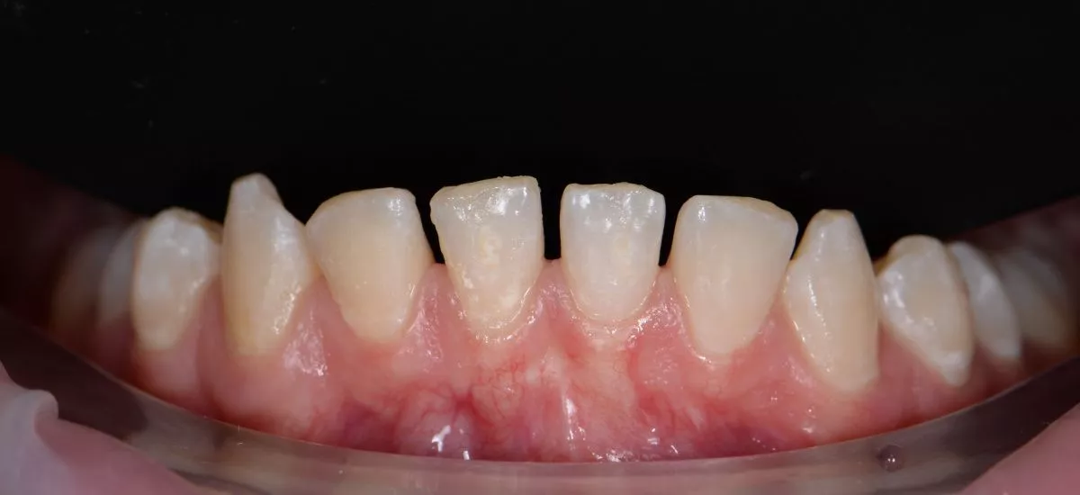Лучшие стоматологические клиники. Восстановление эстетики нижних фронтальных зубов композитными винирами - до процедуры