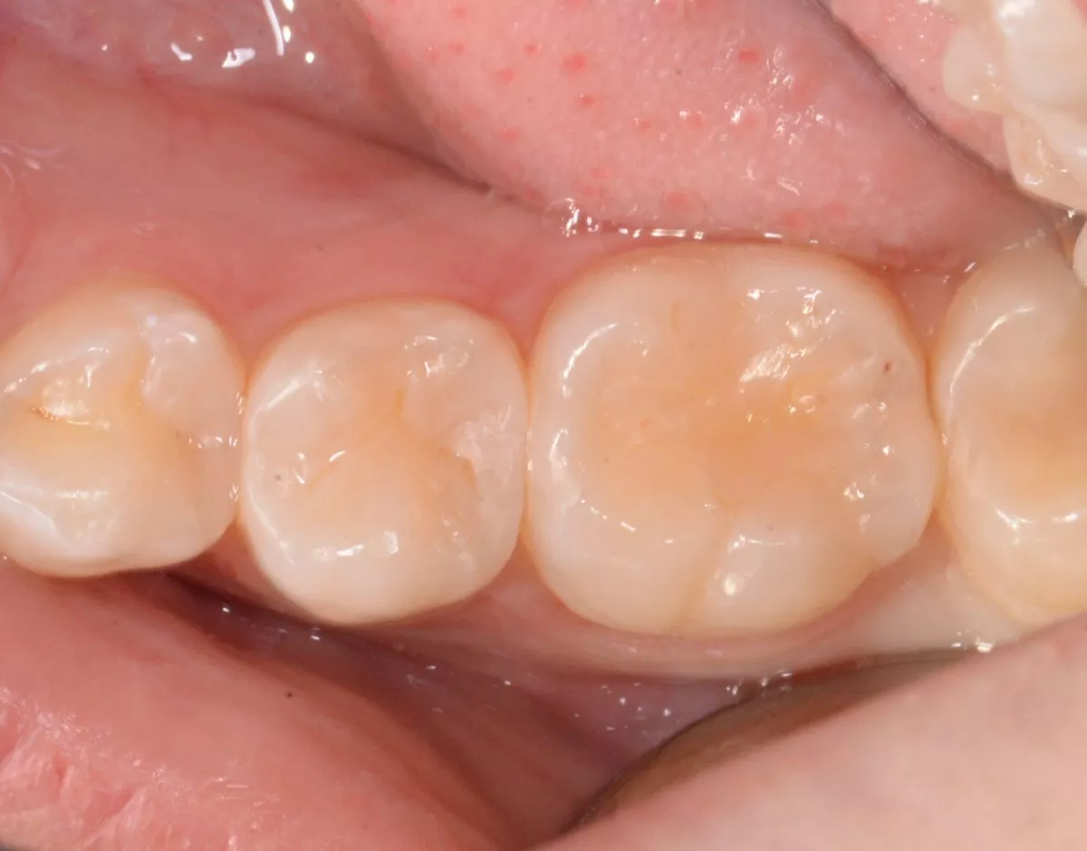 Стоматологии премиум класса в Москве. Поверхностный кариес фиссур – терапия без осложнений - до процедуры