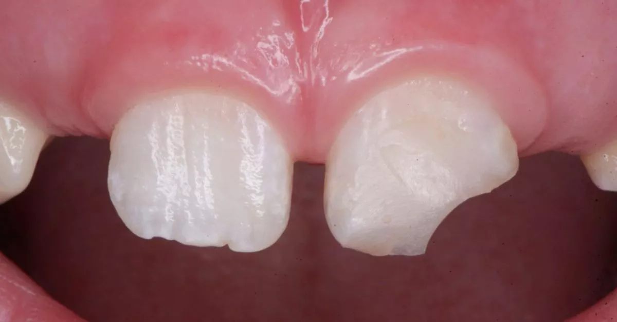 Стоматология Москва лучшие клиники. Восстановление эстетики фронтального зубы - до процедуры