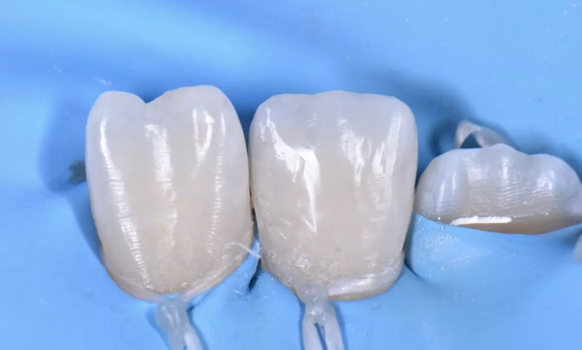 Стоматология Москва лучшие клиники. Прямая реставрация центрального резца нижней челюсти