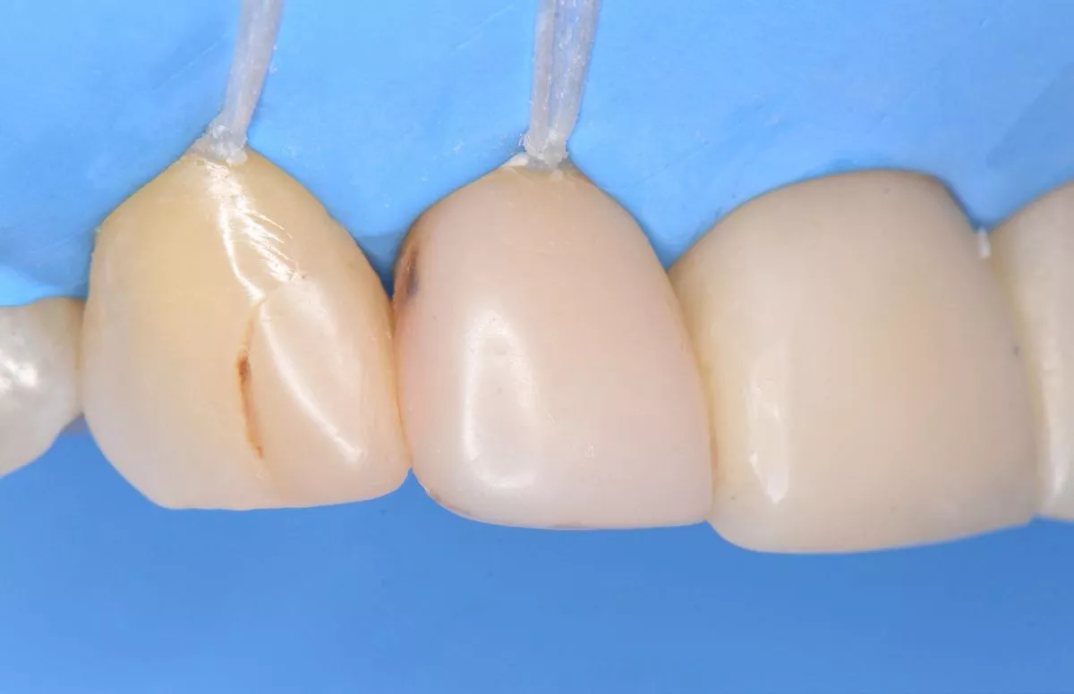 Лечение кариеса с эстетической реставрацией - до процедуры