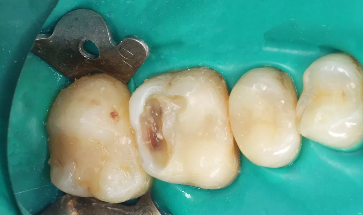 Стоматология премиум класса. Средний кариес жевательной группы зубов - до процедуры